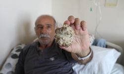 Doktorlar bile şaşkın: Elma büyüklüğünde taş çıktı
