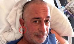 Cem Yılmaz sonrası gündem olan Frank işareti nedir? Kulakta beliren gizemli çizgi ne anlama geliyor?