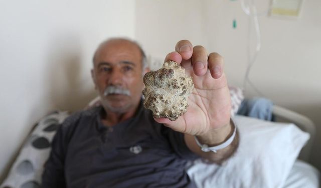 Doktorlar bile şaşkın: Elma büyüklüğünde taş çıktı