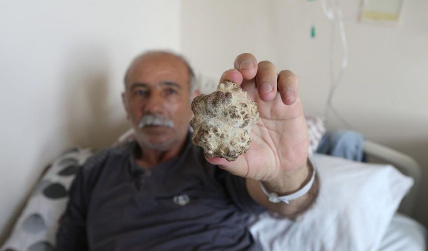 Doktorlar bile şaşkın: Elma büyüklüğünde taş çıktı