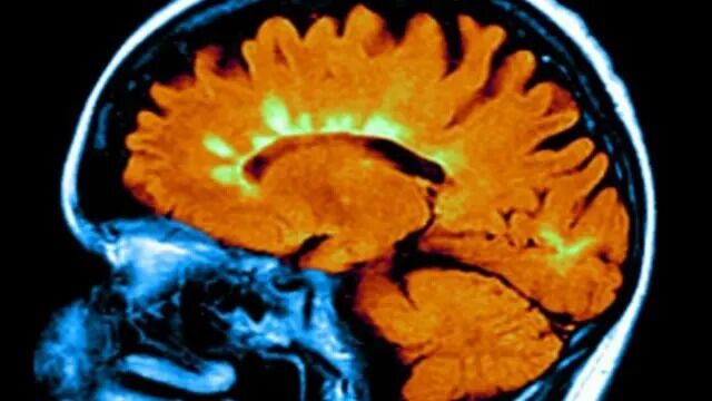 D Vitamini Eksikliği Ile Uyku Ve Beyin Sağlığı Arasında Nasıl Bir Bağ Var Dikkat Çeken Bulgu (2)